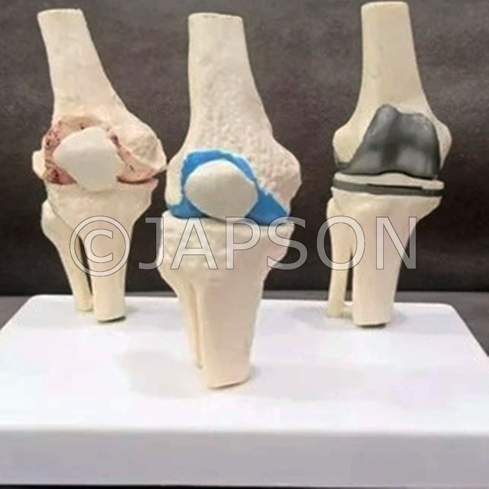 3 Stage Arthritis Knee Model with Implant Model