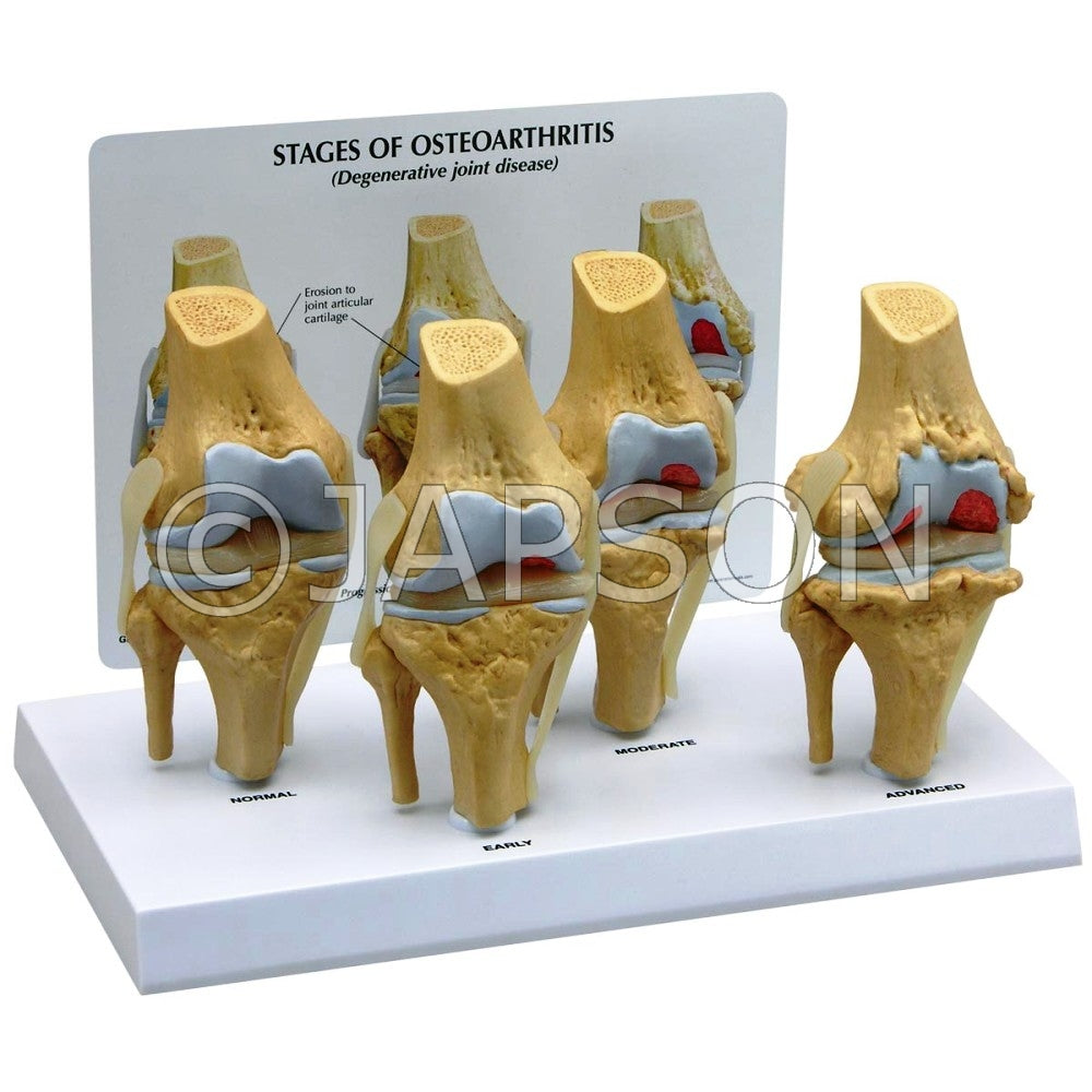 4 Stages Knee Arthritis Model