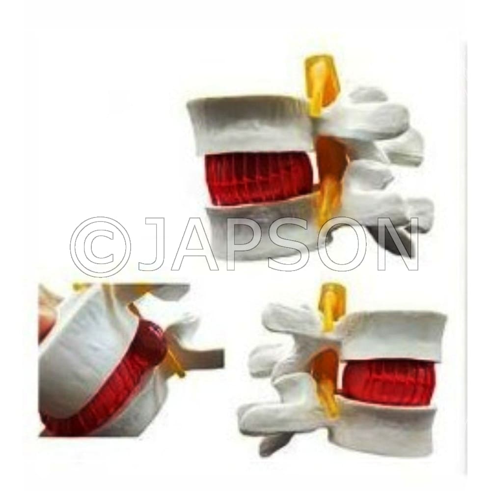 Disc Prolapse Simulator Model