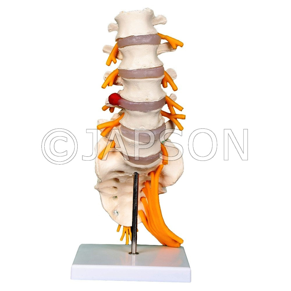 Lumbar Sacrum with Herniated Disc Model