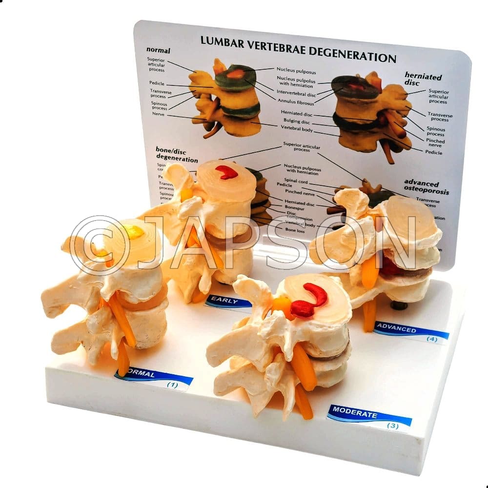 Lumbar Vertebrae Degeneration Model