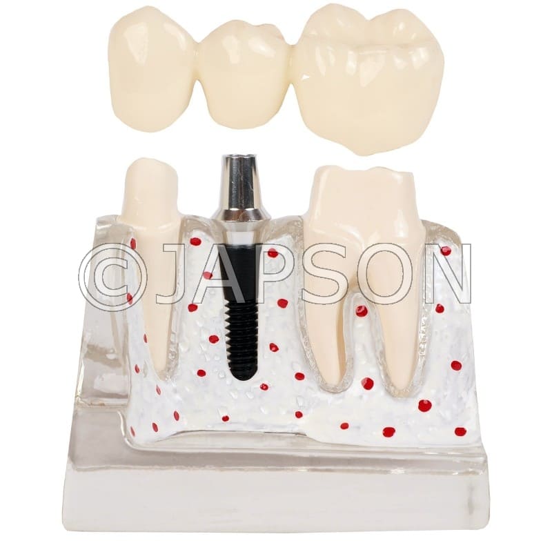 Transparent Enlarged Dental Implant Anatomy Model
