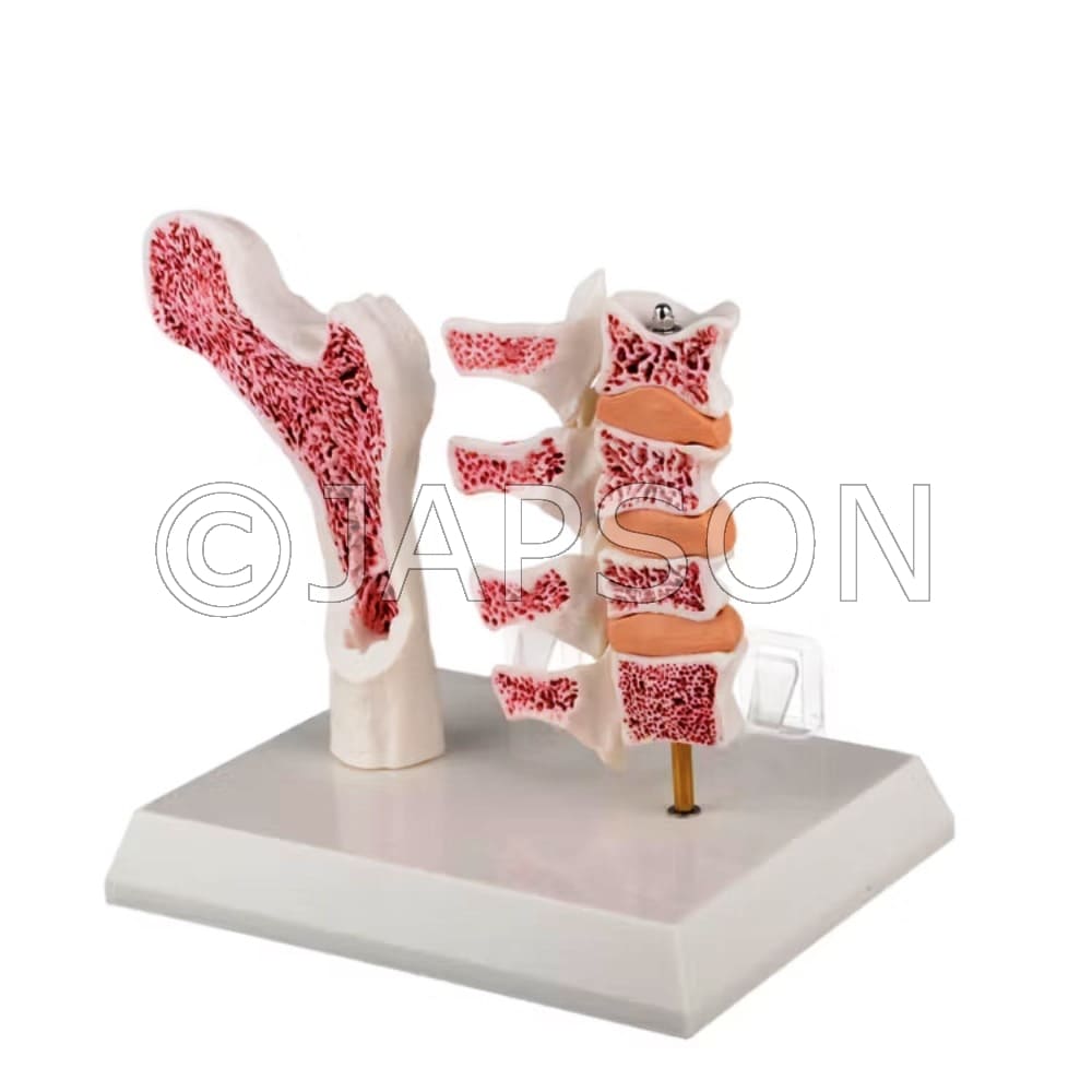 Osteoporosis (Femur & 4 Vertebrae) Model