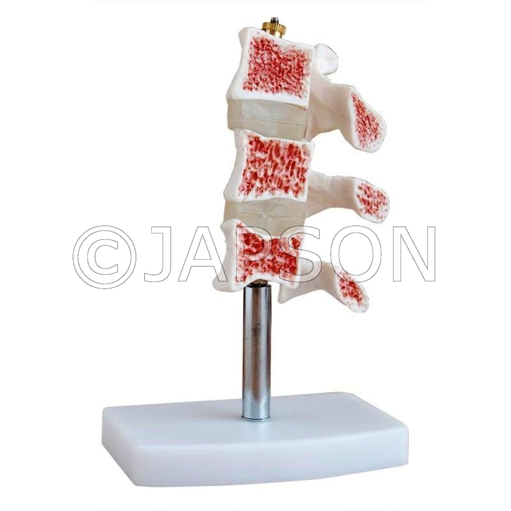Vertebral Osteoporosis Model